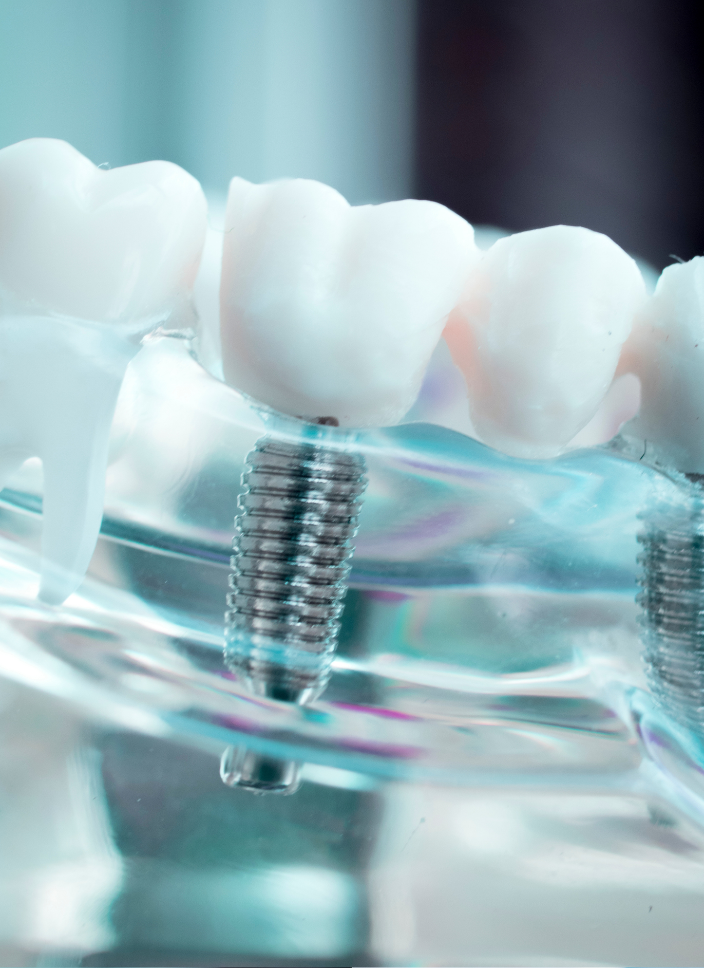 Implant Art Collection – 4-Pack Framed Dental Implant Décor