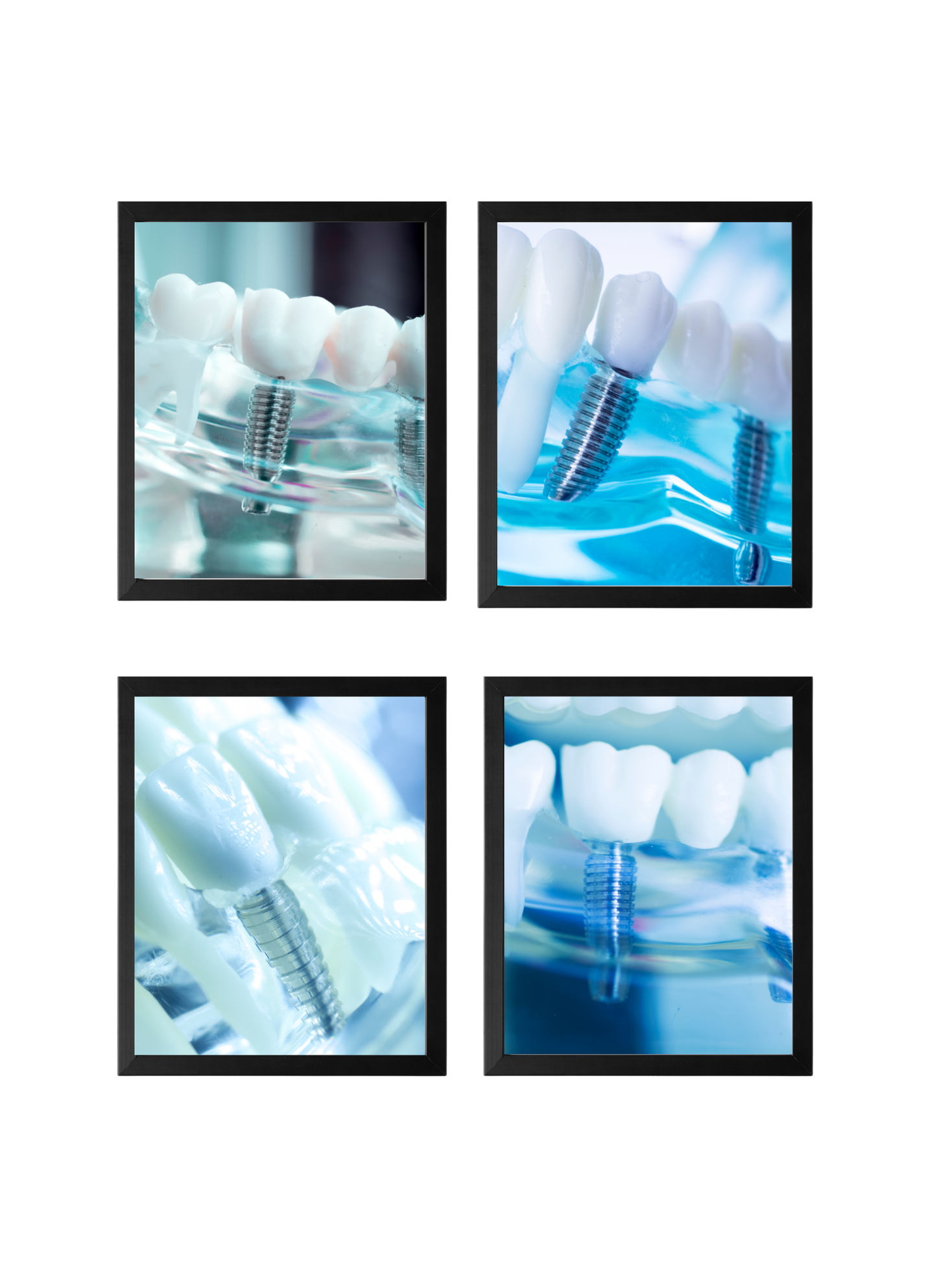 Implant Art Collection – 4-Pack Framed Dental Implant Décor