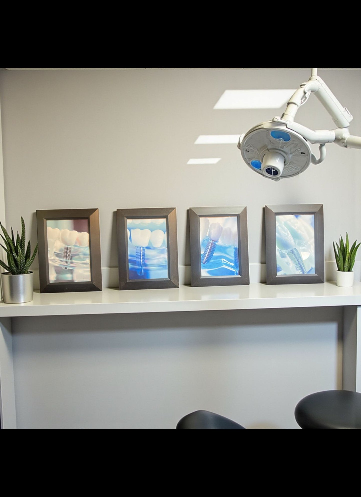 Implant Art Collection – 4-Pack Framed Dental Implant Décor